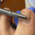 Setzen erster Spangenschenkel