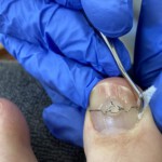 Setzen einer Tamponade