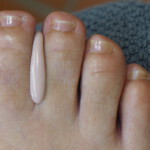 Zwischenzehenorthese