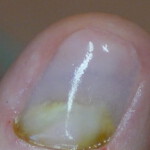 Nagel nach der Prothetik