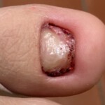 Traumanagel mit Lackresten